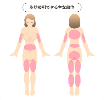 脂肪吸引できる主な部位