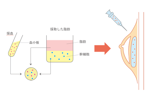 血小板注入の効果と安全性