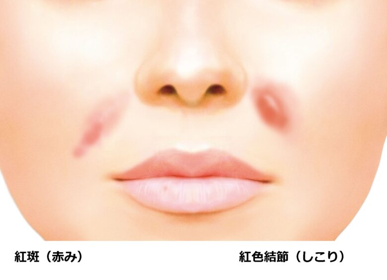 ヒアルロン酸ほうれい線失敗