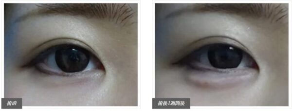 涙袋